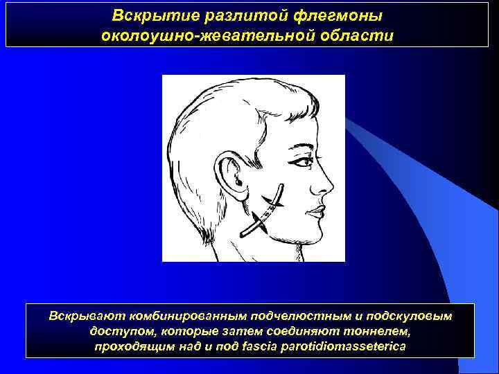 Вскрытие разлитой флегмоны околоушно-жевательной области Вскрывают комбинированным подчелюстным и подскуловым доступом, которые затем соединяют