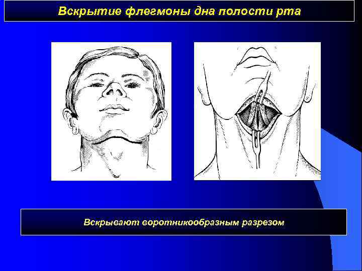 Абсцессы и флегмоны челюстно лицевой области презентация