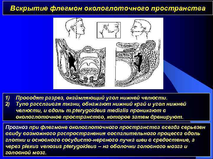 Вскрытие флегмон окологлоточного пространства 1) 2) Проводят разрез, окаймляющий угол нижней челюсти. Тупо расслаивая