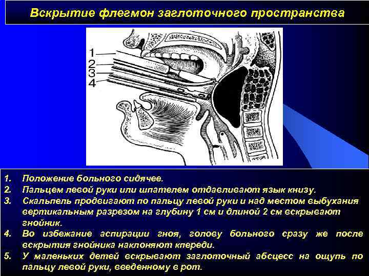 Флегмона голени карта вызова