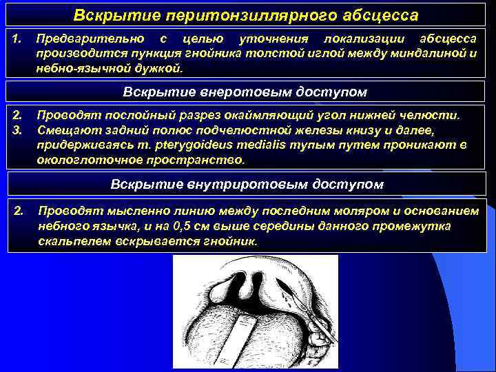 Перитонзиллярный абсцесс карта вызова