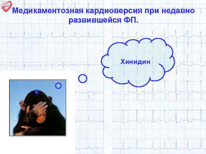 Медикаментозная кардиоверсия при недавно развившейся ФП. Хинидин 