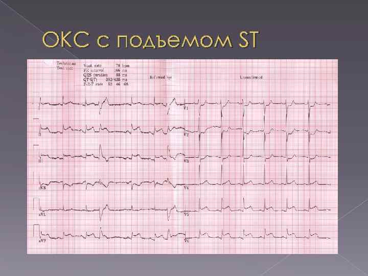ОКС с подъемом ST 