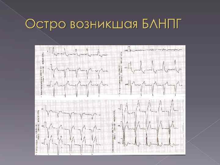 Остро возникшая БЛНПГ 