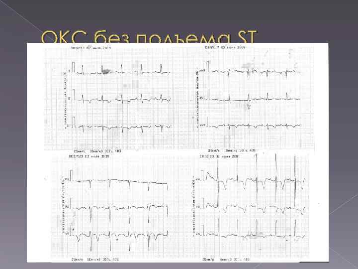 ОКС без подъема ST 