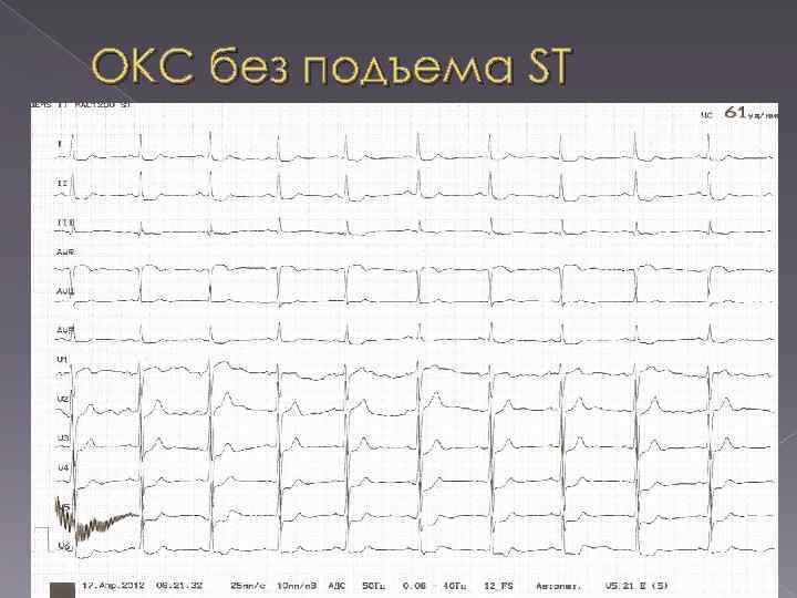 ОКС без подъема ST 