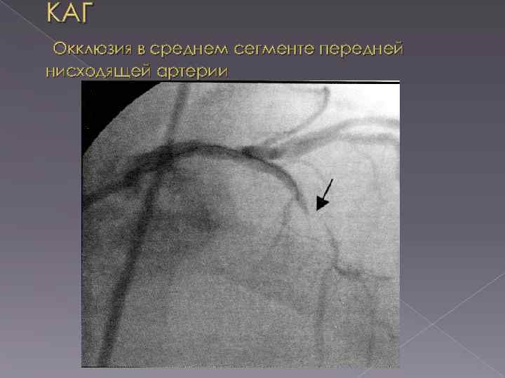 КАГ Окклюзия в среднем сегменте передней нисходящей артерии 