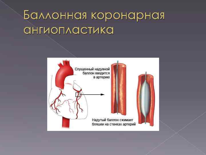 Баллонная коронарная ангиопластика 