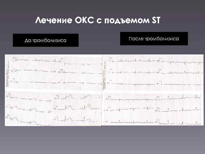 Лечение инфаркта с подъемом st. Окс с подъёмом St. Острый коронарный синдром с подъемом ст. Тромболизис при Окс с подъемом St. ЭКГ при тромболизисе.