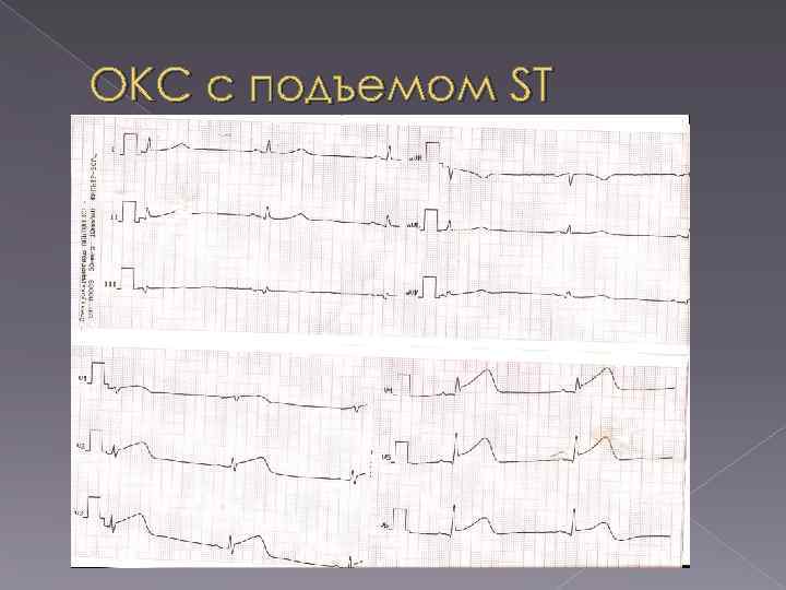 ОКС с подъемом ST 