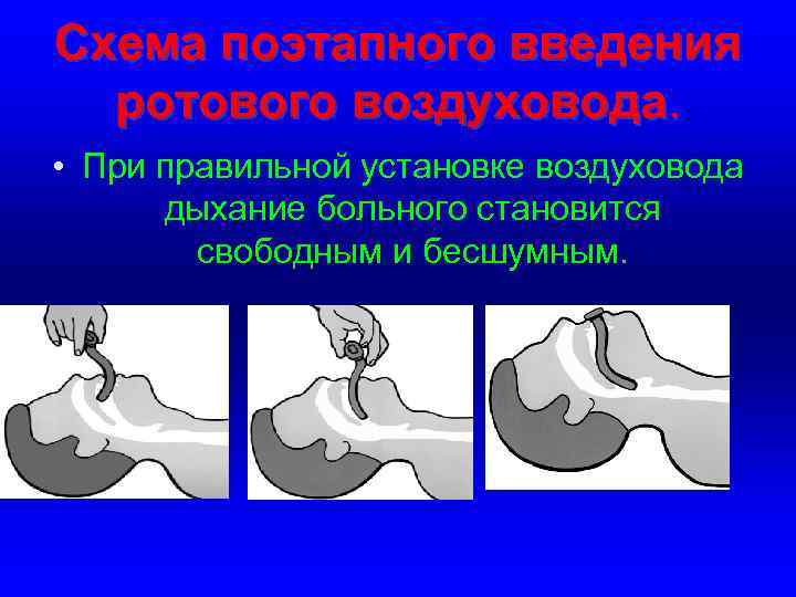Схема поэтапного введения ротового воздуховода. • При правильной установке воздуховода дыхание больного становится свободным