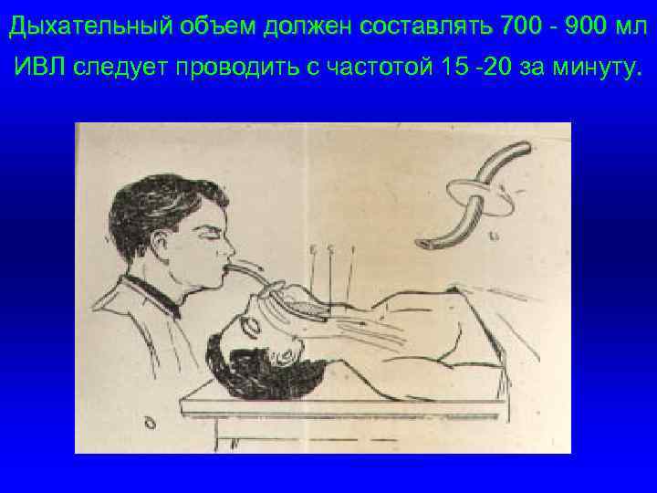 Дыхательный объем должен составлять 700 - 900 мл ИВЛ следует проводить с частотой 15