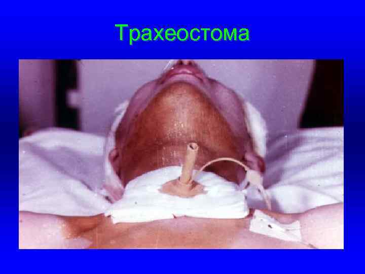 Трахеостома 