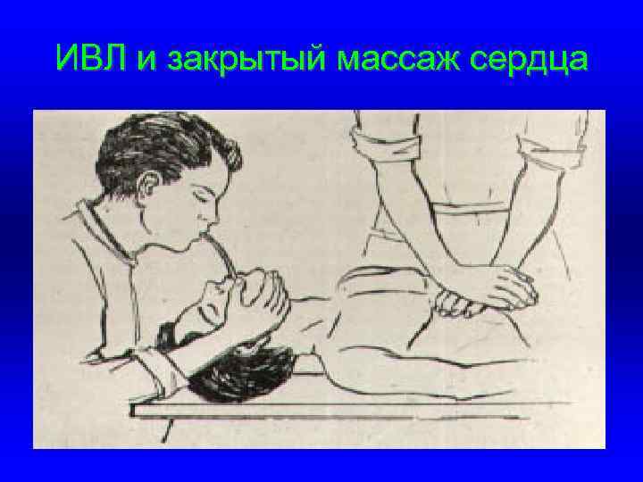 ИВЛ и закрытый массаж сердца 