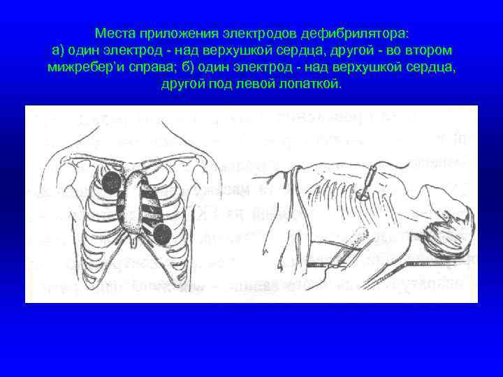 Места приложения электродов дефибрилятора: а) один электрод - над верхушкой сердца, другой - во