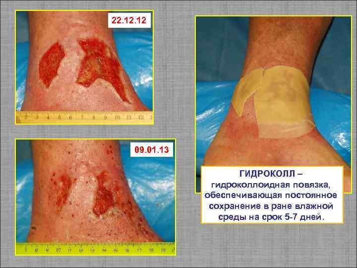 22. 12 09. 01. 13 ГИДРОКОЛЛ – гидроколлоидная повязка, обеспечивающая постоянное сохранение в ране