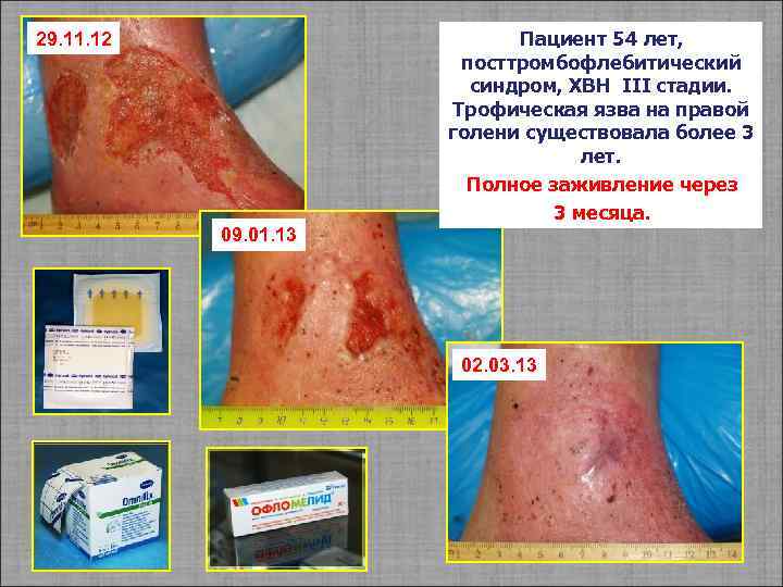 Пациент 54 лет, посттромбофлебитический синдром, ХВН III стадии. Трофическая язва на правой голени существовала