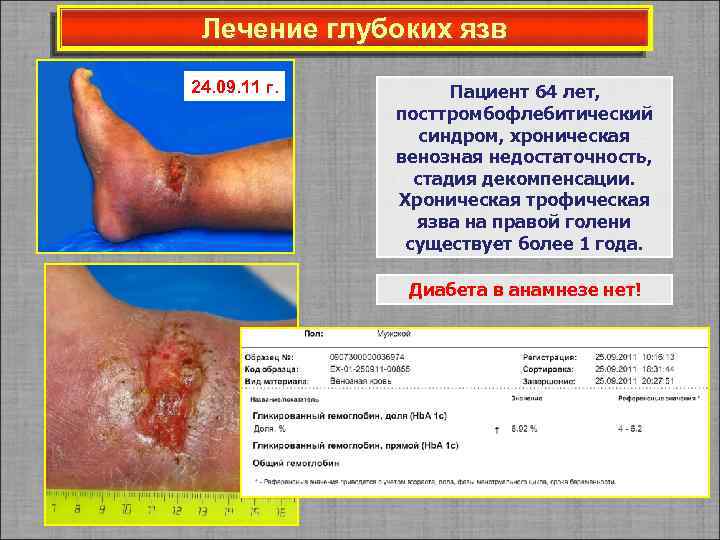 Лечение глубоких язв 24. 09. 11 г. Пациент 64 лет, посттромбофлебитический синдром, хроническая венозная