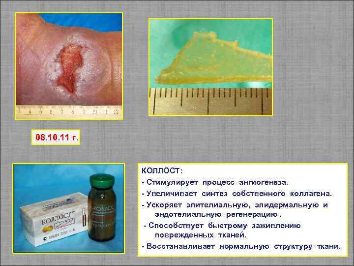 08. 10. 11 г. КОЛЛОСТ: - Стимулирует процесс ангиогенеза. - Увеличивает синтез собственного коллагена.