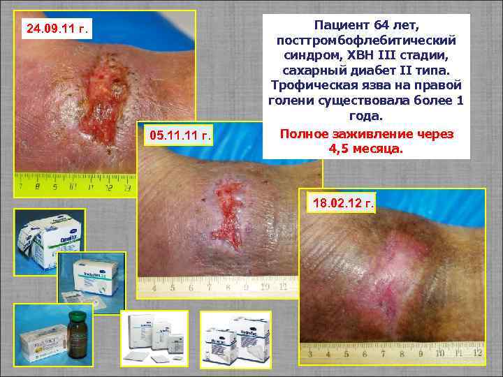 24. 09. 11 г. 05. 11 г. Пациент 64 лет, посттромбофлебитический синдром, ХВН III
