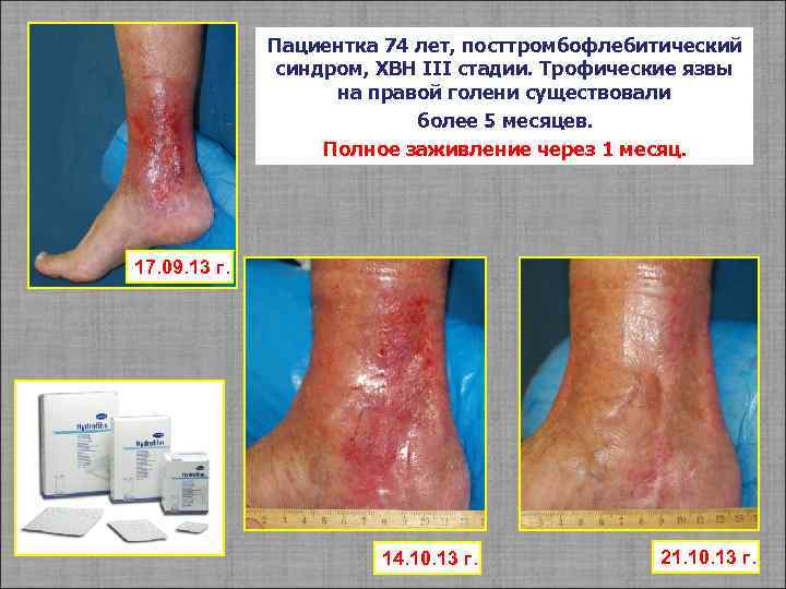 Пациентка 74 лет, посттромбофлебитический синдром, ХВН III стадии. Трофические язвы на правой голени существовали