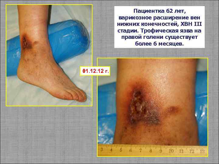 Пациентка 62 лет, варикозное расширение вен нижних конечностей, ХВН III стадии. Трофическая язва на