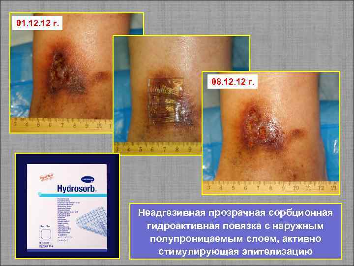 01. 12 г. 08. 12 г. Неадгезивная прозрачная сорбционная гидроактивная повязка с наружным полупроницаемым