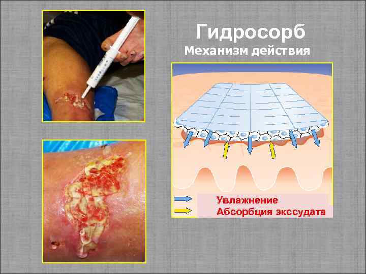 Гидросорб Механизм действия Увлажнение Абсорбция экссудата 