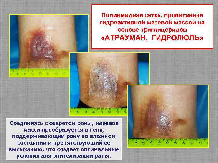 Полиамидная сетка, пропитанная гидроактивной мазевой массой на основе триглицеридов «АТРАУМАН, ГИДРОЛЮЛЬ» Соединяясь с секретом