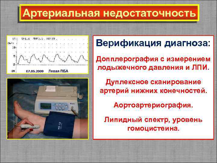 Артериальная недостаточность Верификация диагноза: Допплерография с измерением лодыжечного давления и ЛПИ. Дуплексное сканирование артерий