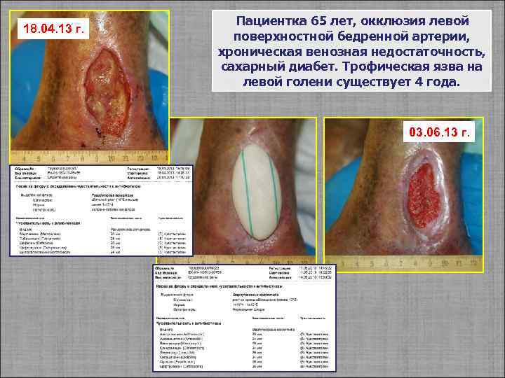 18. 04. 13 г. Пациентка 65 лет, окклюзия левой поверхностной бедренной артерии, хроническая венозная