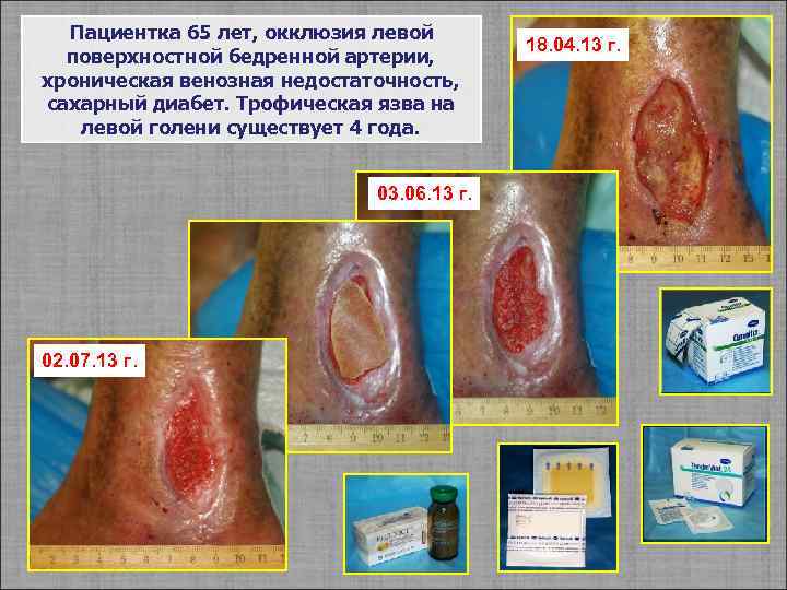 Пациентка 65 лет, окклюзия левой поверхностной бедренной артерии, хроническая венозная недостаточность, сахарный диабет. Трофическая