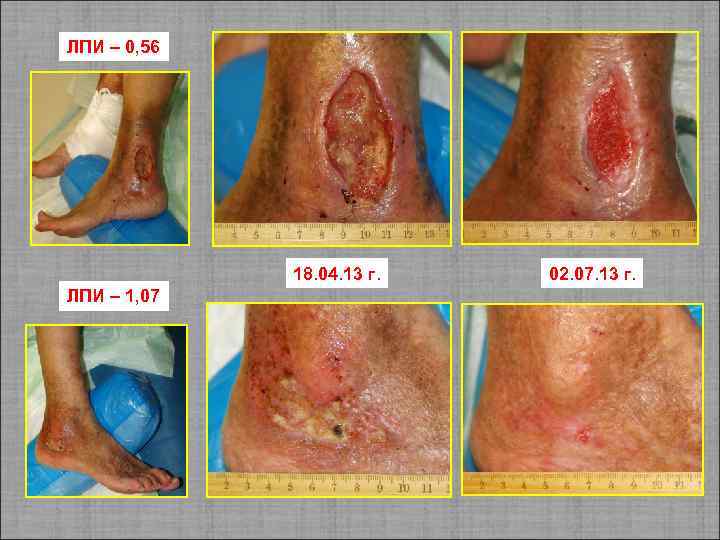 ЛПИ – 0, 56 18. 04. 13 г. ЛПИ – 1, 07 02. 07.