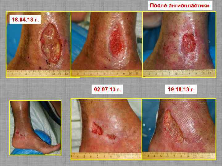 После ангиопластики 18. 04. 13 г. 02. 07. 13 г. 19. 10. 13 г.