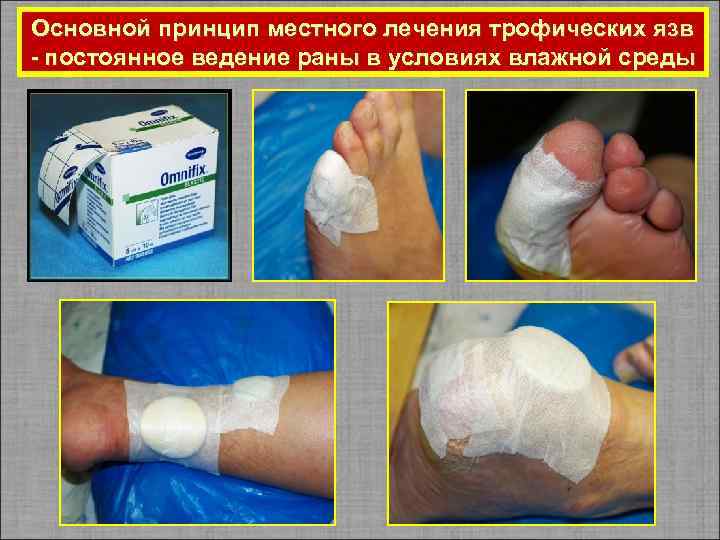 Основной принцип местного лечения трофических язв - постоянное ведение раны в условиях влажной среды