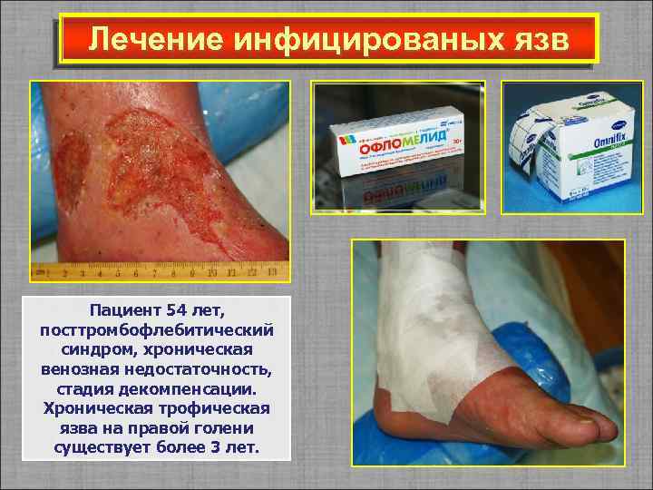 Лечение инфицированых язв Пациент 54 лет, посттромбофлебитический синдром, хроническая венозная недостаточность, стадия декомпенсации. Хроническая