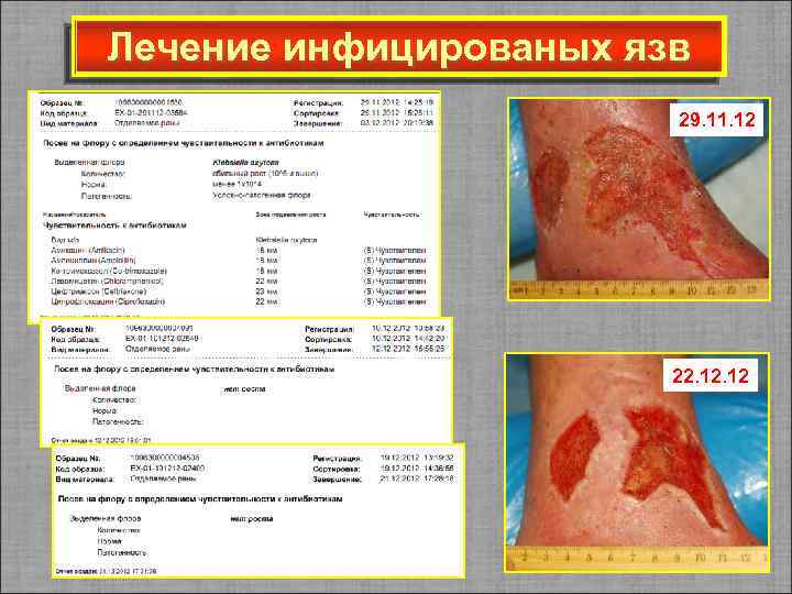 Лечение инфицированых язв 29. 11. 12 22. 12 