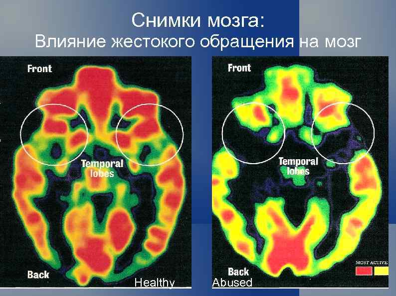 Снимки мозга: Влияние жестокого обращения на мозг Healthy Abused 