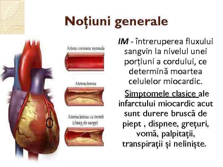 Noțiuni generale IM - întreruperea fluxului sangvin la nivelul unei porțiuni a cordului, ce