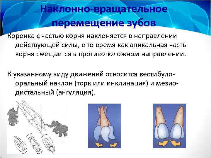 Наклонно-вращательное перемещение зубов Коронка с частью корня наклоняется в направлении действующей силы, в то