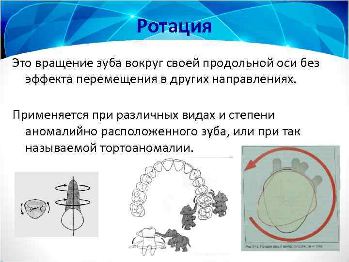 Ротация Это вращение зуба вокруг своей продольной оси без эффекта перемещения в других направлениях.