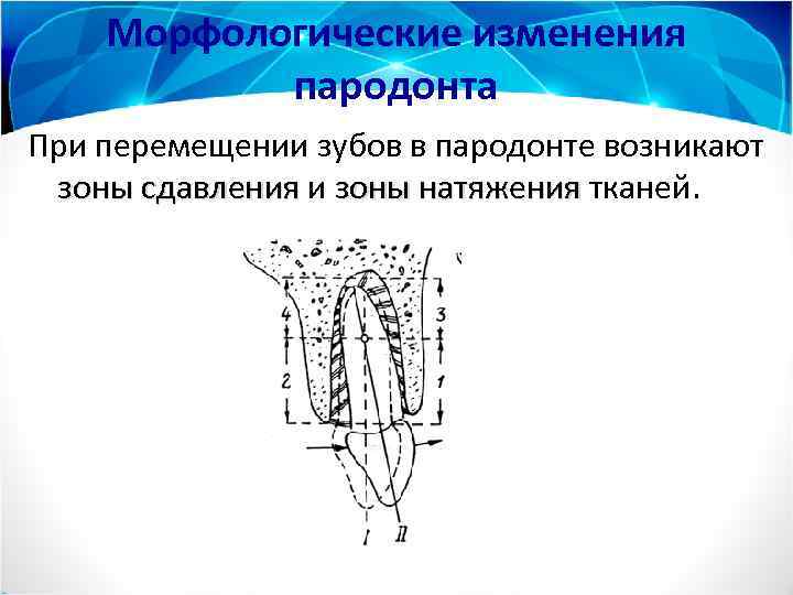Морфологические изменения пародонта При перемещении зубов в пародонте возникают зоны сдавления и зоны натяжения