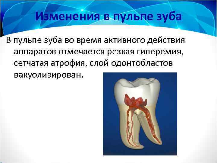 Изменения в пульпе зуба В пульпе зуба во время активного действия аппаратов отмечается резкая