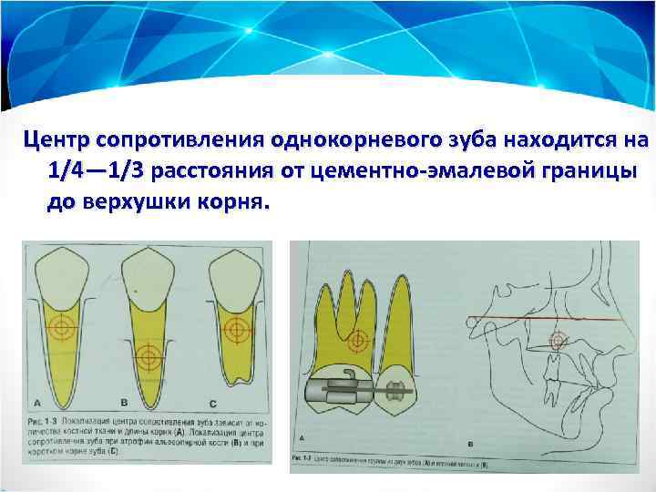 Центр сопротивления однокорневого зуба находится на 1/4— 1/3 расстояния от цементно-эмалевой границы до верхушки