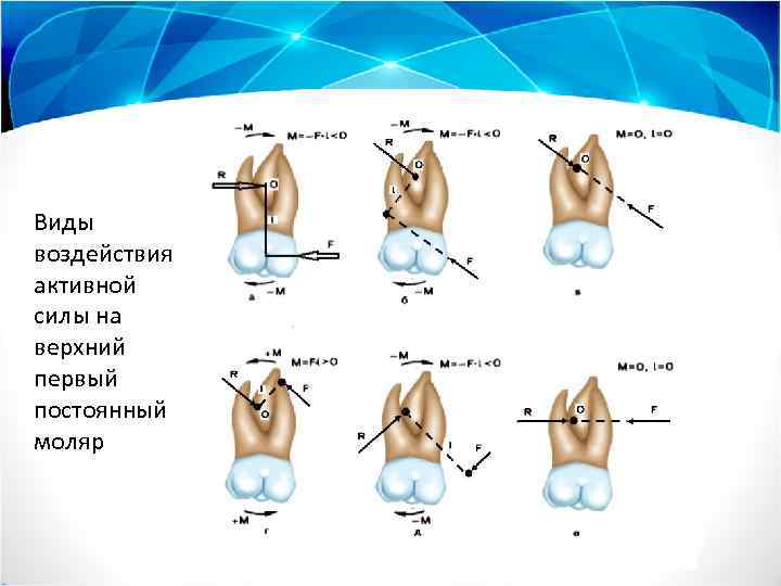 Виды воздействия активной силы на верхний первый постоянный моляр 