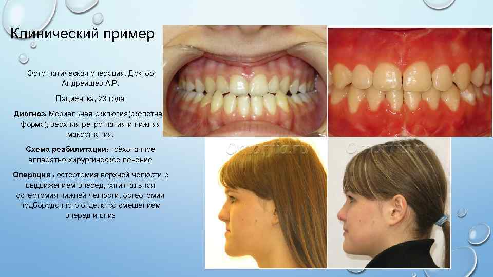 Клинический пример Ортогнатическая операция. Доктор Андреищев А. Р. Пациентка, 23 года Диагноз: Мезиальная окклюзия(скелетная