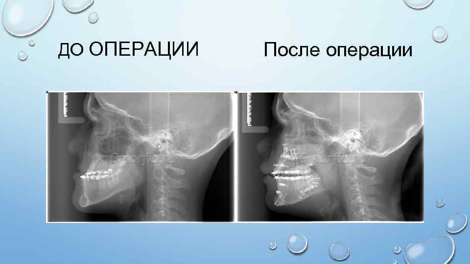 ДО ОПЕРАЦИИ После операции 