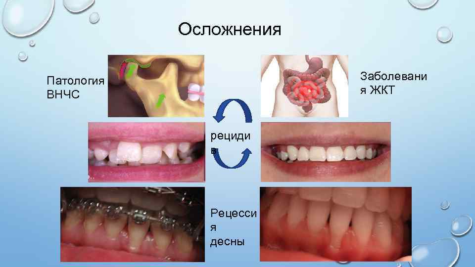 Осложнения Заболевани я ЖКТ Патология ВНЧС рециди в Рецесси я десны 