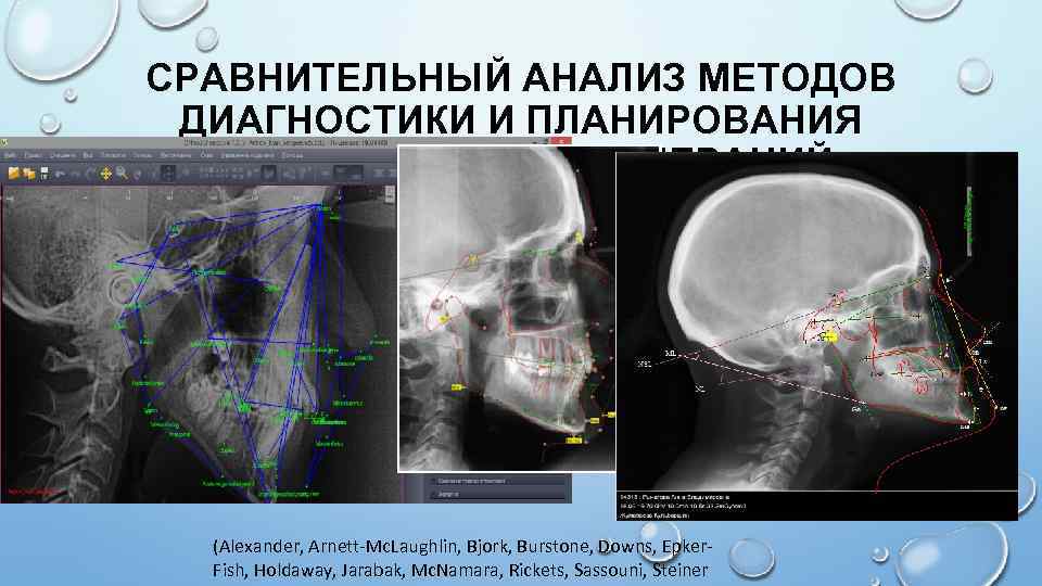 СРАВНИТЕЛЬНЫЙ АНАЛИЗ МЕТОДОВ ДИАГНОСТИКИ И ПЛАНИРОВАНИЯ ОРТОГНАТИЧЕСКИХ ОПЕРАЦИЙ. (Alexander, Arnett-Mc. Laughlin, Bjork, Burstone, Downs,