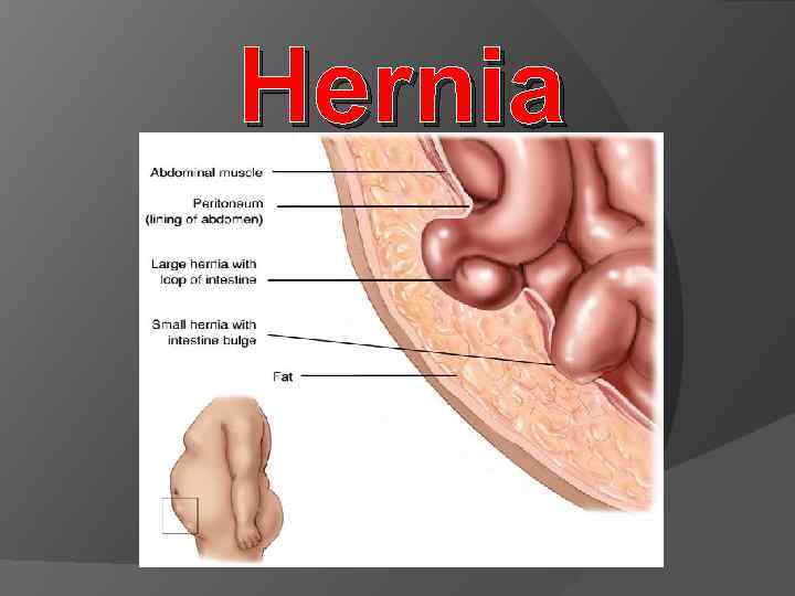 Hernia 